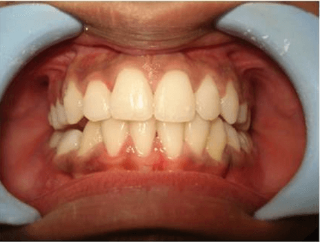 After treatment - Patient 1